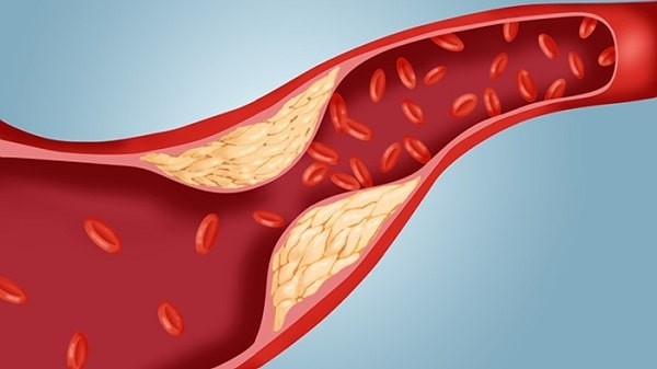 Bệnh tăng cholesterol máu làm tăng nguy cơ tim mạch