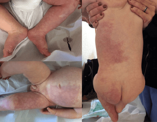 Hội chứng Klippel-Trenaunay xảy ra ở trẻ