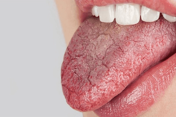 Khô miệng là một trong hai triệu chứng thường gặp nhất