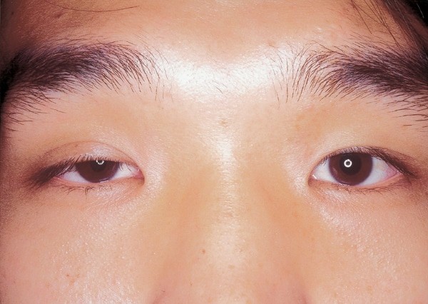 Sụp mí mắt là triệu chứng của hội chứng Horner