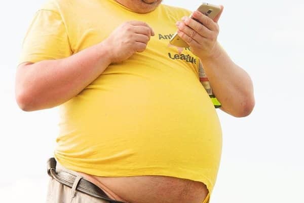 Người béo phì có nguy cơ cao hơn mắc triệu chứng này
