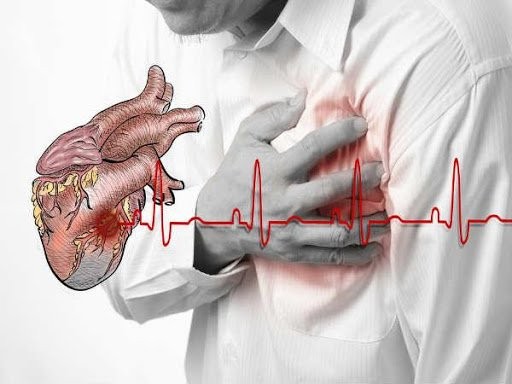    Có nhiều nguyên nhân dẫn đến ngưng tim đột ngột