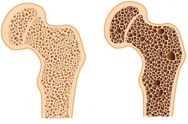 Xương khỏe mạnh (bên trái) và loãng xương (bên phải)
