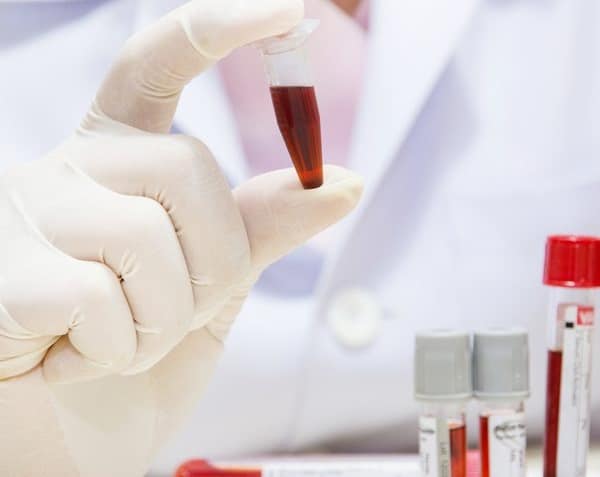 Xét nghiệm chẩn đoán Sarcoidosis