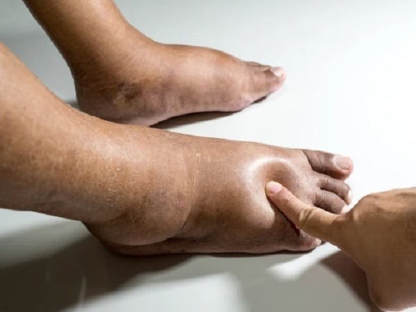 Phù hai chân là triệu chứng thường gặp của bệnh cầu thận màng