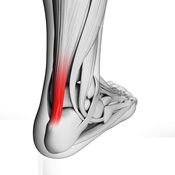 Gân gót ở sau gót chân, gân gót ngắn có thể gây ra tật đi nhón chân ở trẻ.