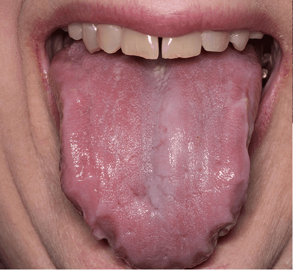 Hình ảnh của phì đại lưỡi do thoái hóa tinh bột