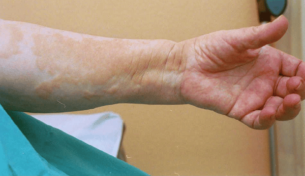 Bệnh xơ hóa hệ thống nguồn gốc thận có thể biểu hiện giống một số bệnh ngoài da