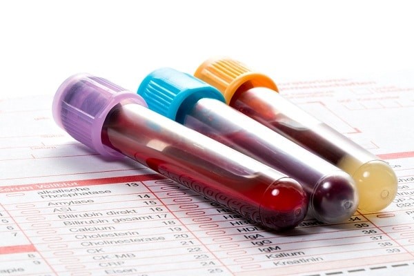 Xét nghiệm máu tìm kháng thể giúp chẩn đoán bệnh mô liên kết hỗn hợp