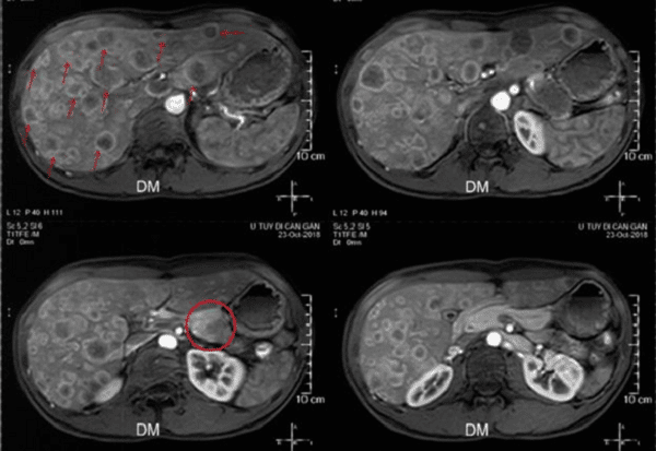 Một hình ảnh MRI cho thấy có u tế bào cận hạch thần kinh di căn ổ bụng
