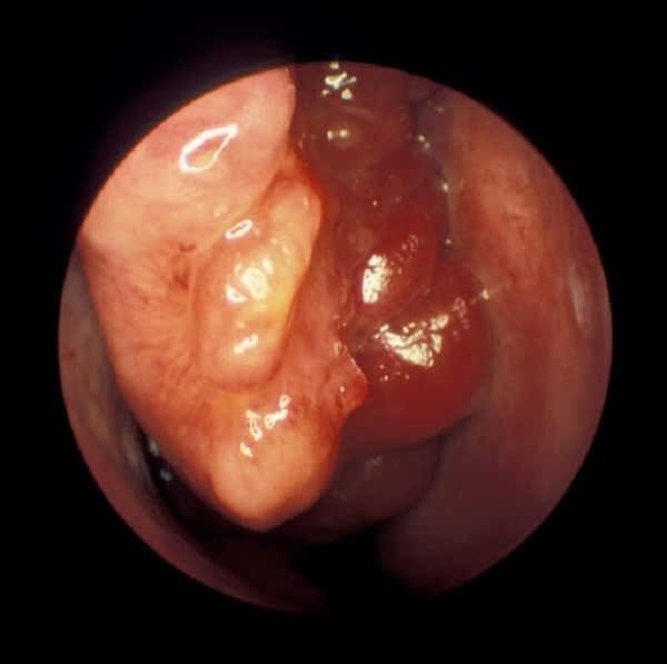 Hình ảnh nội soi phát hiện khối u vùng mũi trong.