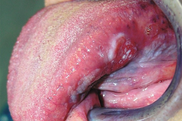 Ung thư miệng có nhiều dấu hiệu cảnh báo