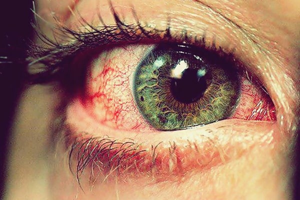 Đỏ, ngứa mắt khi thiếu vitamin B2