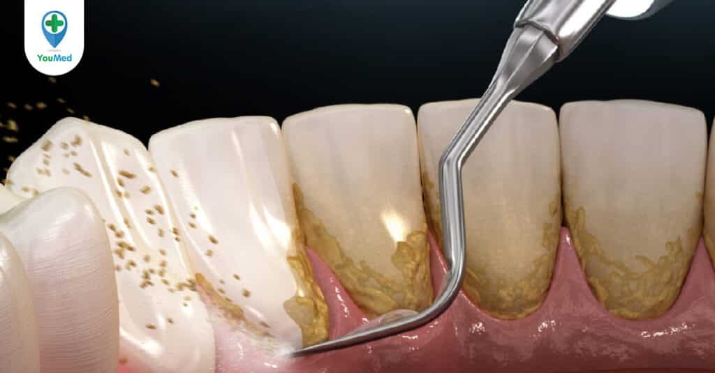 Những điều cần biết về vôi răng