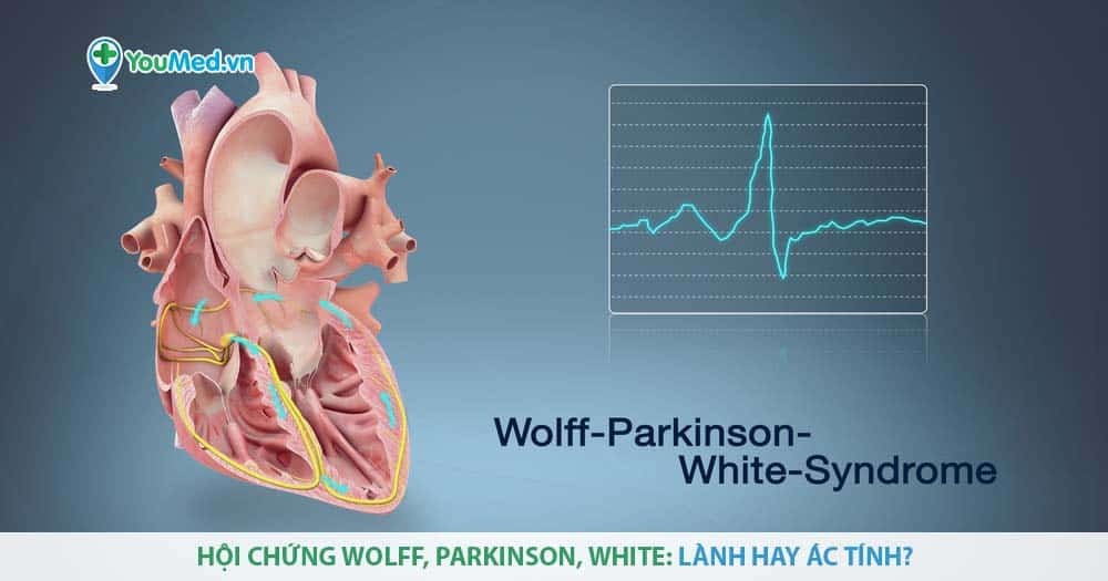 Hội chứng Wolff, Parkinson, White là bệnh gì? Nguyên nhân, dấu hiệu và điều trị