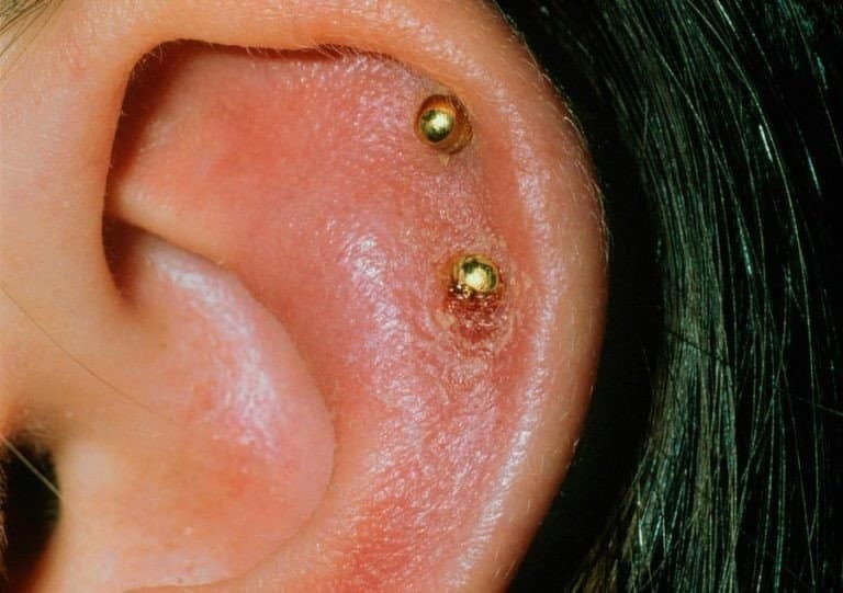 Viêm sụn vành tai có thể xảy ra sau bấm khuyên tai