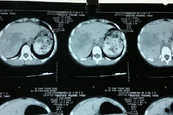 Chụp CT vùng bụng