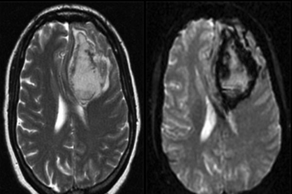 Chụp MRI sọ não