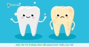 Điều trị tủy ở răng vĩnh viễn đang phát triển của trẻ