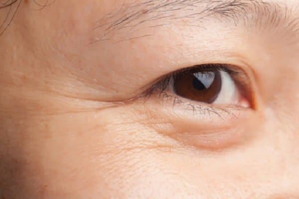Nếp nhăn vùng mắt do lão hóa