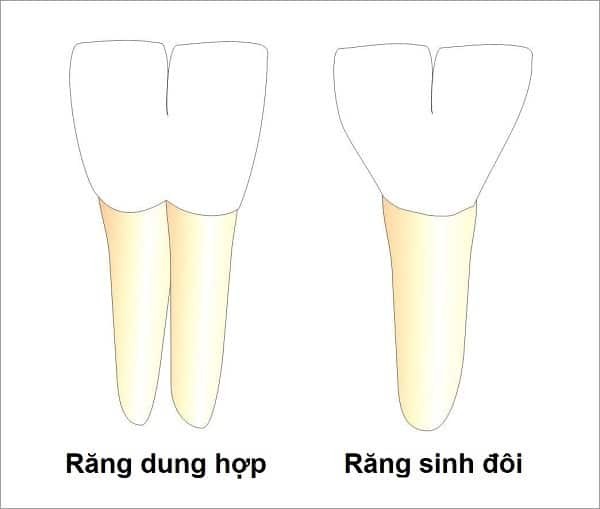Phân biệt răng sinh đôi và răng dung hợp