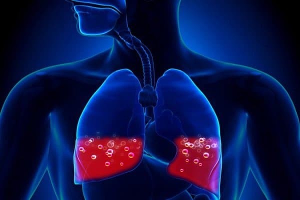Phù phổi cấp - Cách chữa bệnh ho