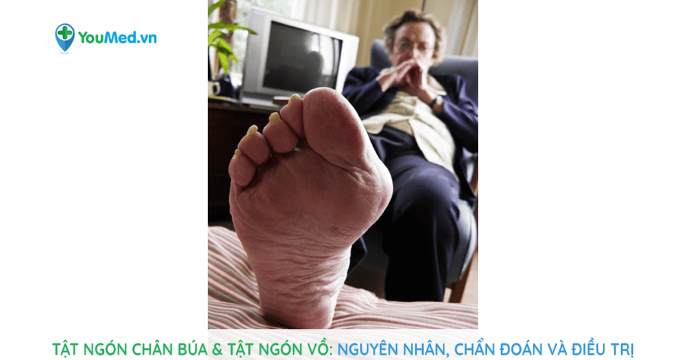 Tật ngón chân búa & tật ngón vồ: chẩn đoán và điều trị.