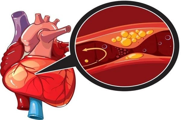 Thiếu máu cục bộ cơ tim cấp tính - Tăng huyết áp ác tính