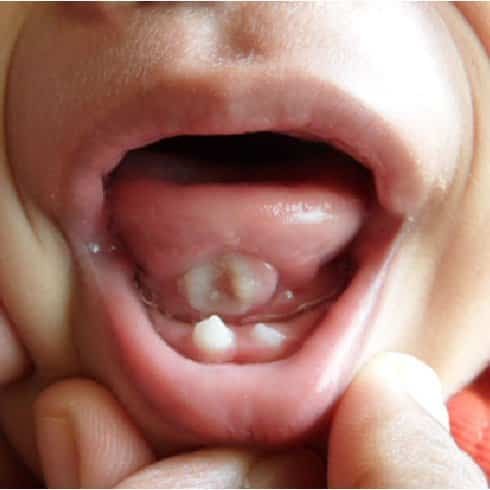 Vết loét dưới lưỡi Rigar-Fede do răng bẩm sinh