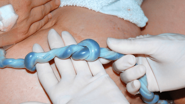 Mẹ nên làm gì khi em bé có dây rốn thắt nút trong thai kỳ?