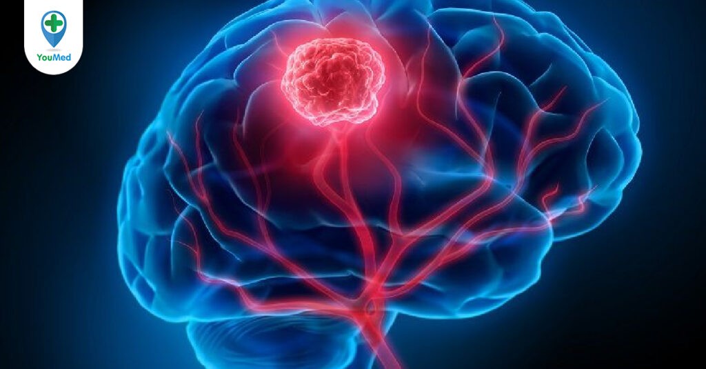 Bệnh giả u não: Nguyên nhân, chẩn đoán và điều trị