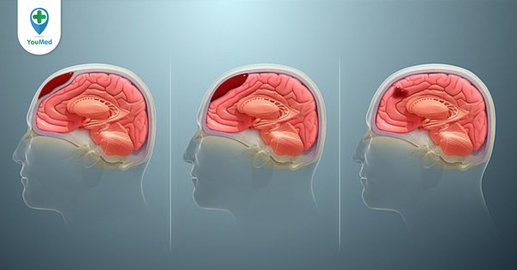 Tụ máu nội sọ: Những điều bạn cần biết!