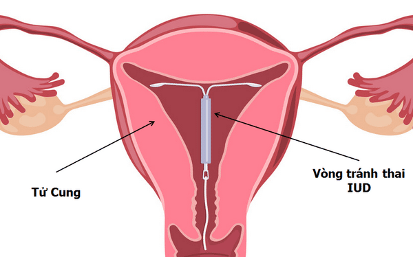 vị trí của vòng trong tử cung