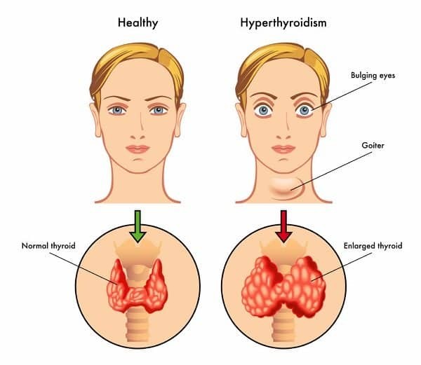 Minh họa người bình thường (bên trái) với người bị suy giáp (bên phải), với các triệu chứng gồm lồi mắt, bướu cổ, phì đai tuyến giáp