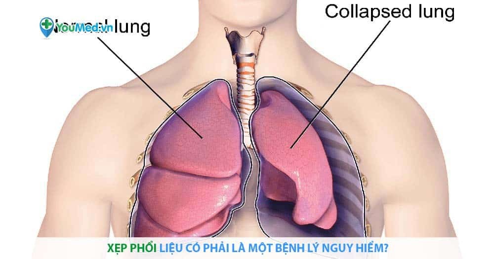 Xẹp phổi là gì? Liệu có phải bệnh lý nguy hiểm không?
