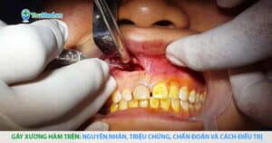 Gãy xương hàm trên: nguyên nhân, triệu chứng, chẩn đoán và cách điều trị