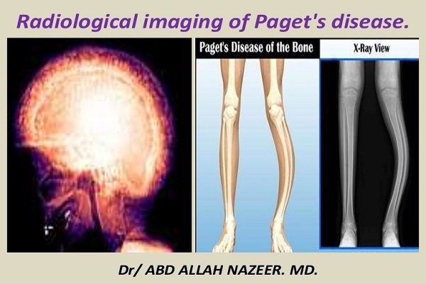 Bệnh xương của Paget