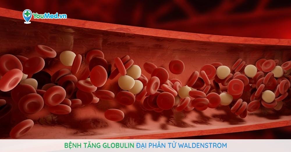 Bệnh tăng Globulin đại phân tử Waldenstrom
