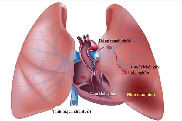 Thuyên tắc phổi do huyết khối