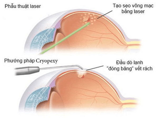 Phương pháp phẫu thuật laser
