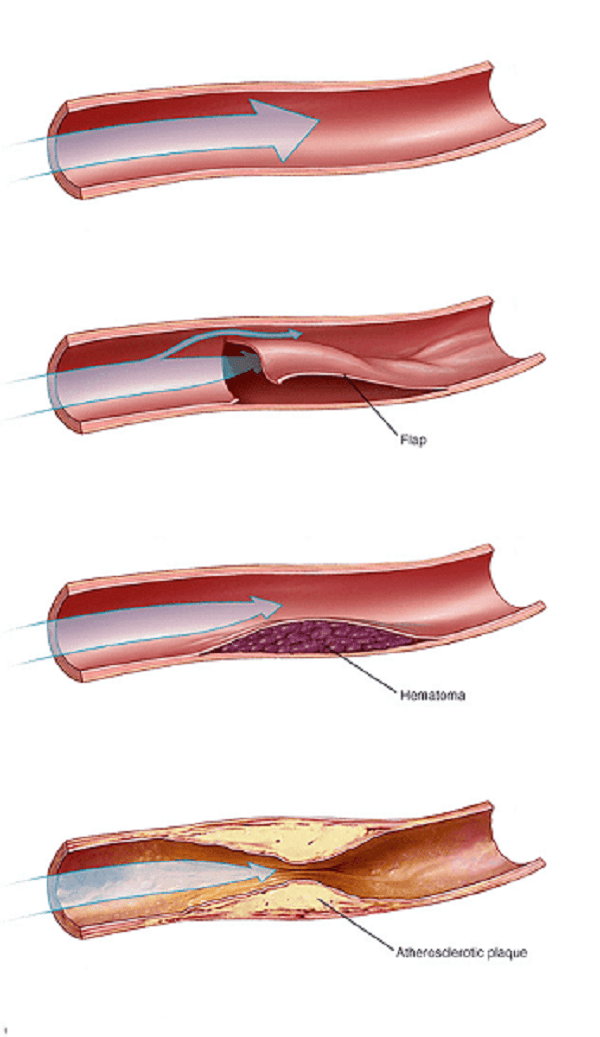 Diễn tiến bóc tách động mạch vành