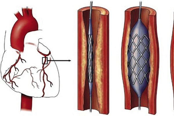  Đặt stent động mạch vành