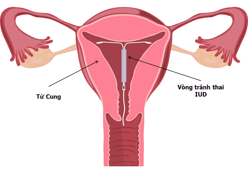 Vòng tránh thai bị lệch khỏi vị trí có thể khiến phụ nữ đau bụng mỗi khi đến kỳ kinh nguyệt