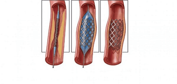  Nong và đặt stent mạch thận là thủ thuật để thông chỗ hẹp giúp cải thiện lưu lượng máu đến thận