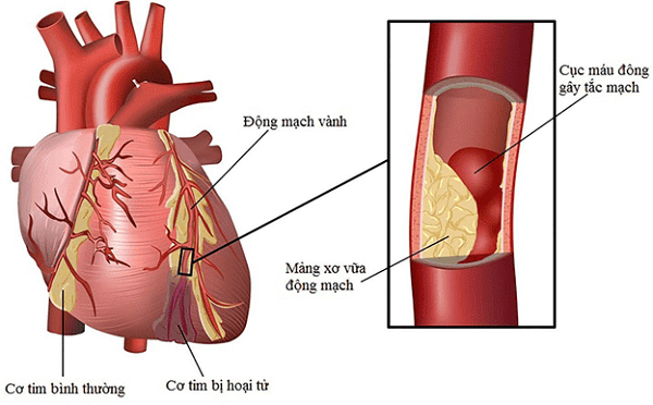 Nhồi máu cơ tim là nguyên nhân thường gặp
