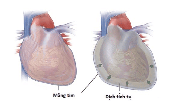 Tràn dịch gây chèn ép tim