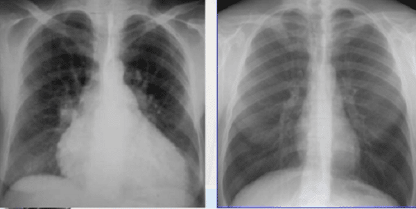  X Quang tim trước và sau tràn dịch