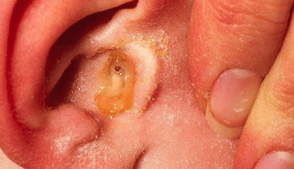  Hình minh họa triệu chứng bệnh nhiễm trùng tai