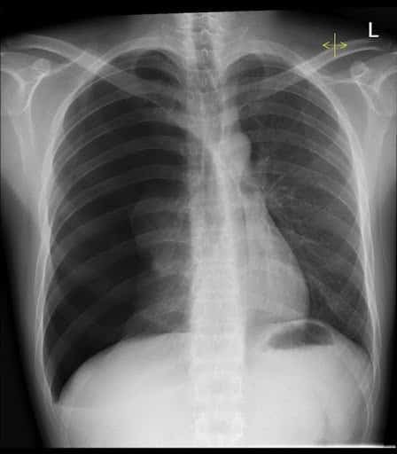 Hình ảnh tràn khí màng phổi bên phải trên X-Quang