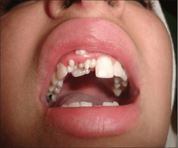 Hình ảnh bệnh nhân bị u răng
